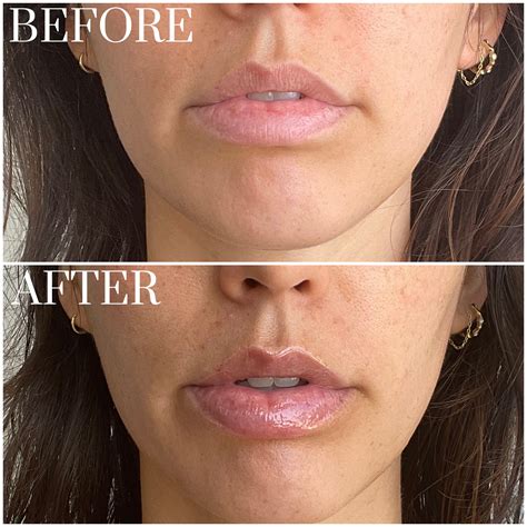 Lip Treatments 